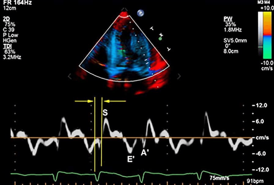 Ecocardiograma tissular
